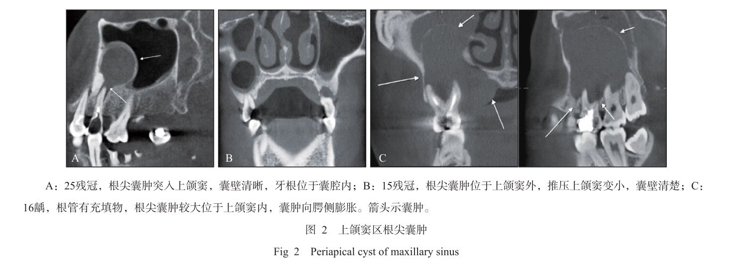 上颌窦根尖囊肿