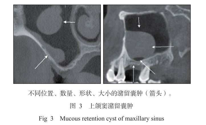 上颌窦潴留囊肿