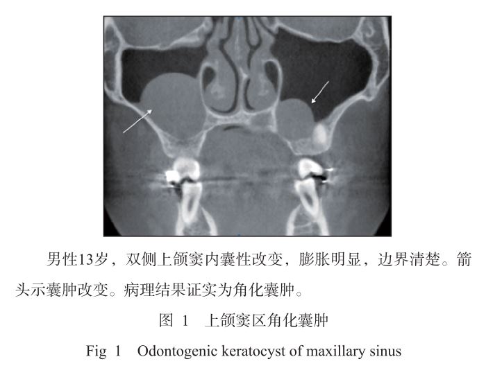 上颌窦角化囊肿