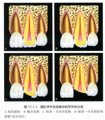 牙外伤分类1.JPG