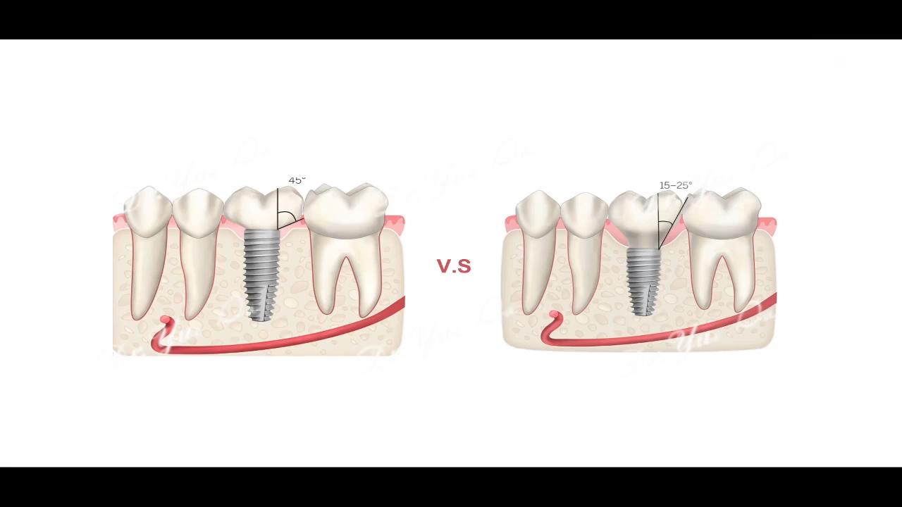精准派_种植戴牙的流程和细节把控_20220113220659