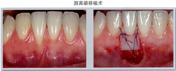 游离龈移植技术.JPG