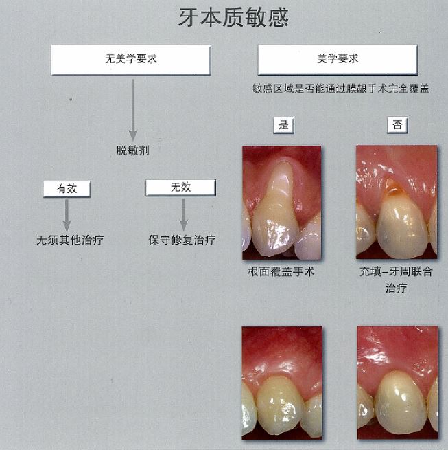 牙本质敏感.JPG